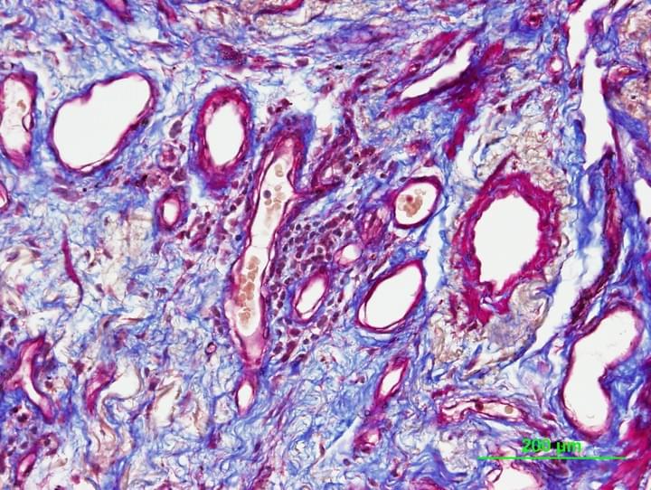 IPF Lung Fibrosis or scarring