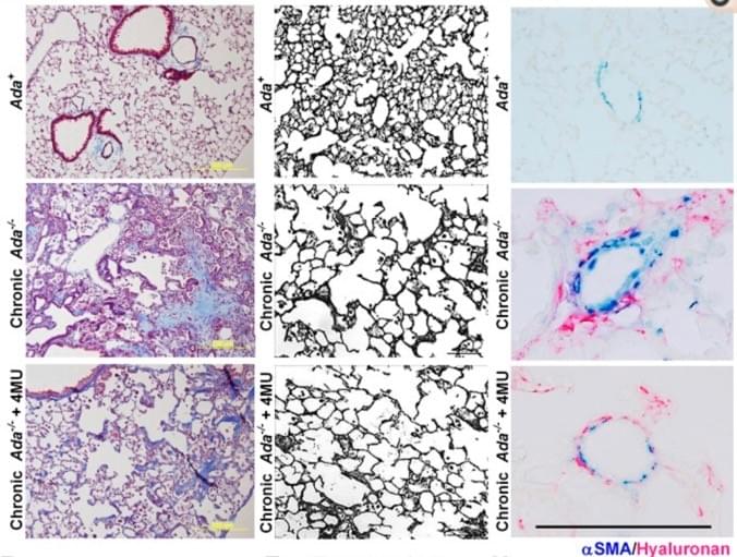 Adenosine and Hyaluronan modulate lung fibrosis and pulmonary hypertension in Combined Pulmonary Fibrosis and Emphysema (CPFE)