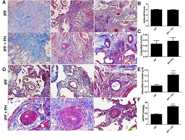 Group III Pulmonary Hypertension (PH)