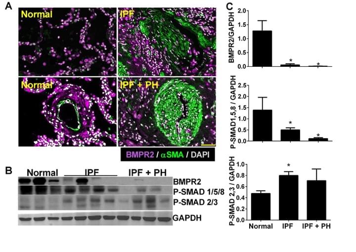 BMPR2 IPF and lung Fibrosis