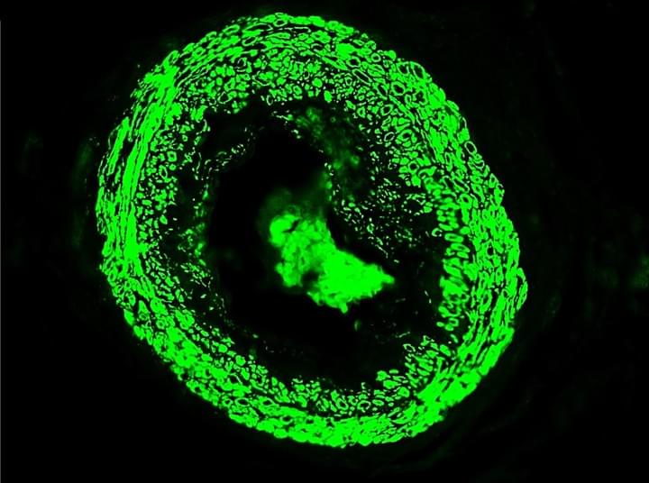 Pulmonary Hypertension Vascular Remodeling
