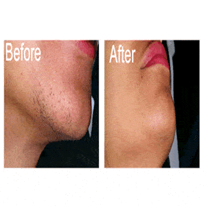 Laser Hair Removal