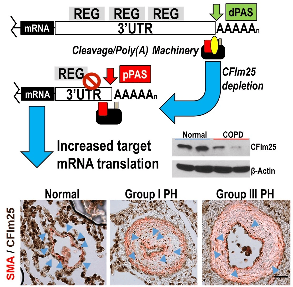 Alternative Polyadenylation Pulmonary Hypertension
