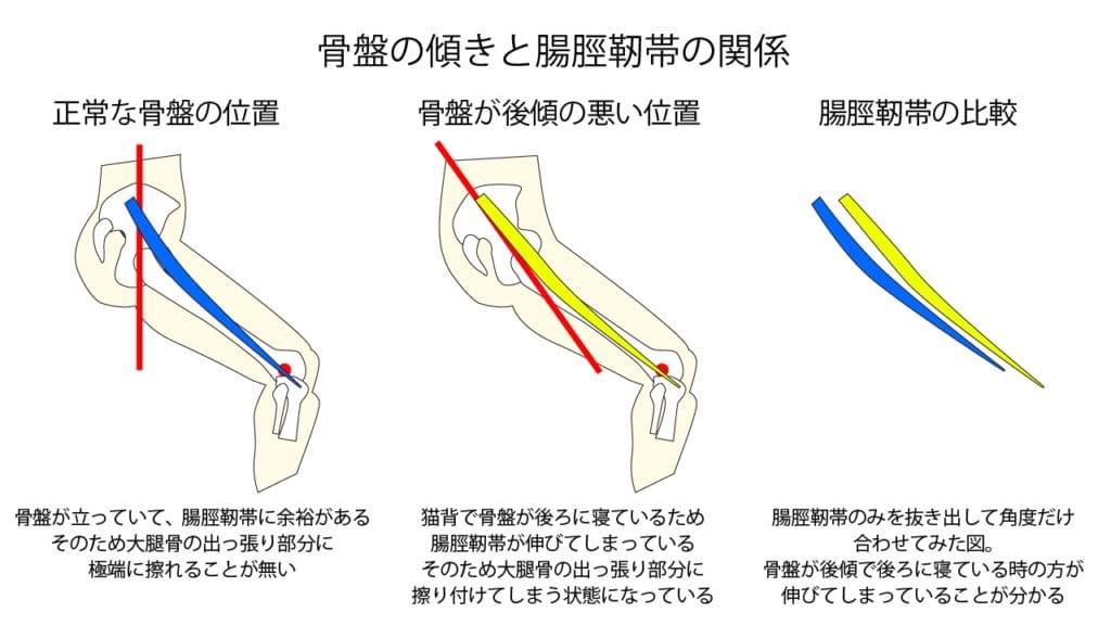 骨盤の傾き 骨盤の傾き
