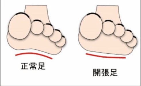 開張足 開張足