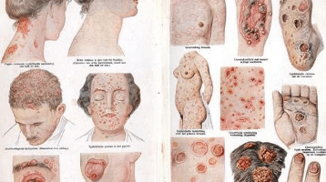TIPS MENGATASI SIPILIS DENGAN BAHAN ALAMI TANPA KE DOKTER TIPS MENGATASI SIPILIS DENGAN BAHAN ALAMI TANPA KE DOKTER
