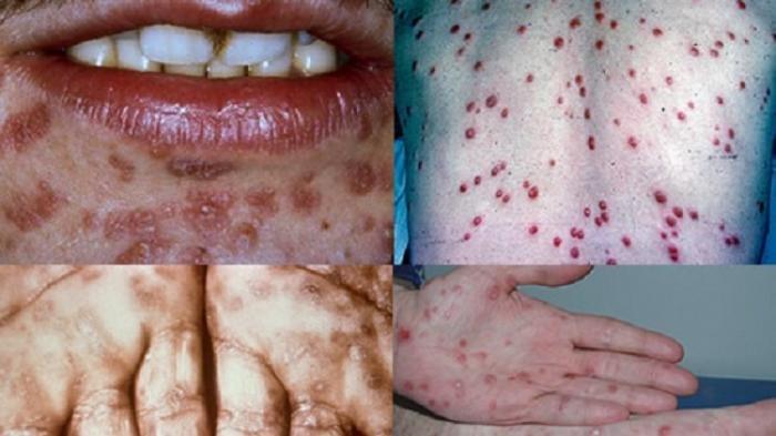 TIPS AMPUH MENGATASI SIPILIS PRIA DAN WANITA TANPA KAMBUH TIPS AMPUH MENGATASI SIPILIS PRIA DAN WANITA TANPA KAMBUH