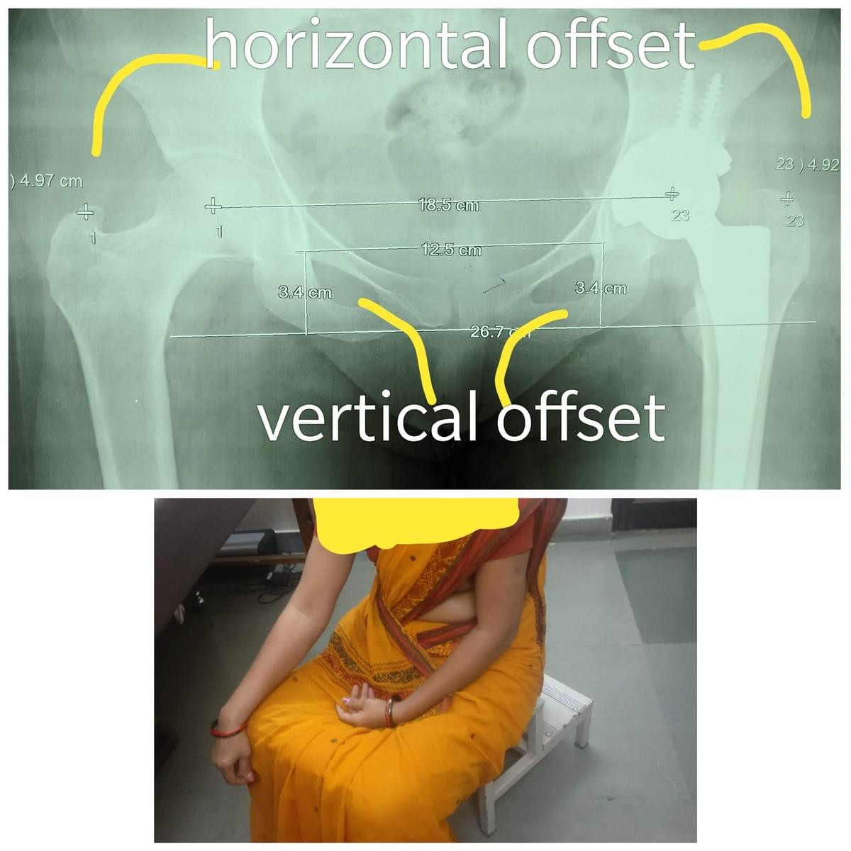 HIP REPLACEMENT HIP REPLACEMENT