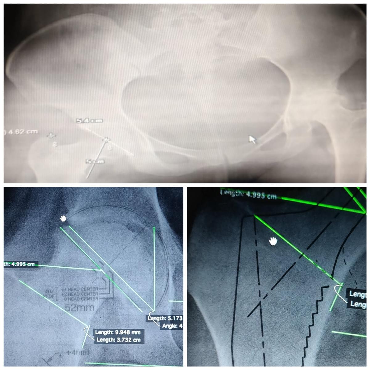 HIP REPLACEMENT HIP REPLACEMENT