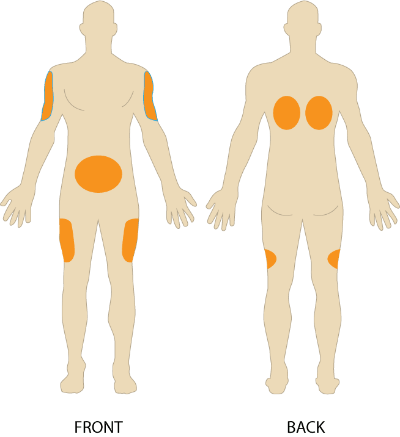 popular injection sites popular injection sites