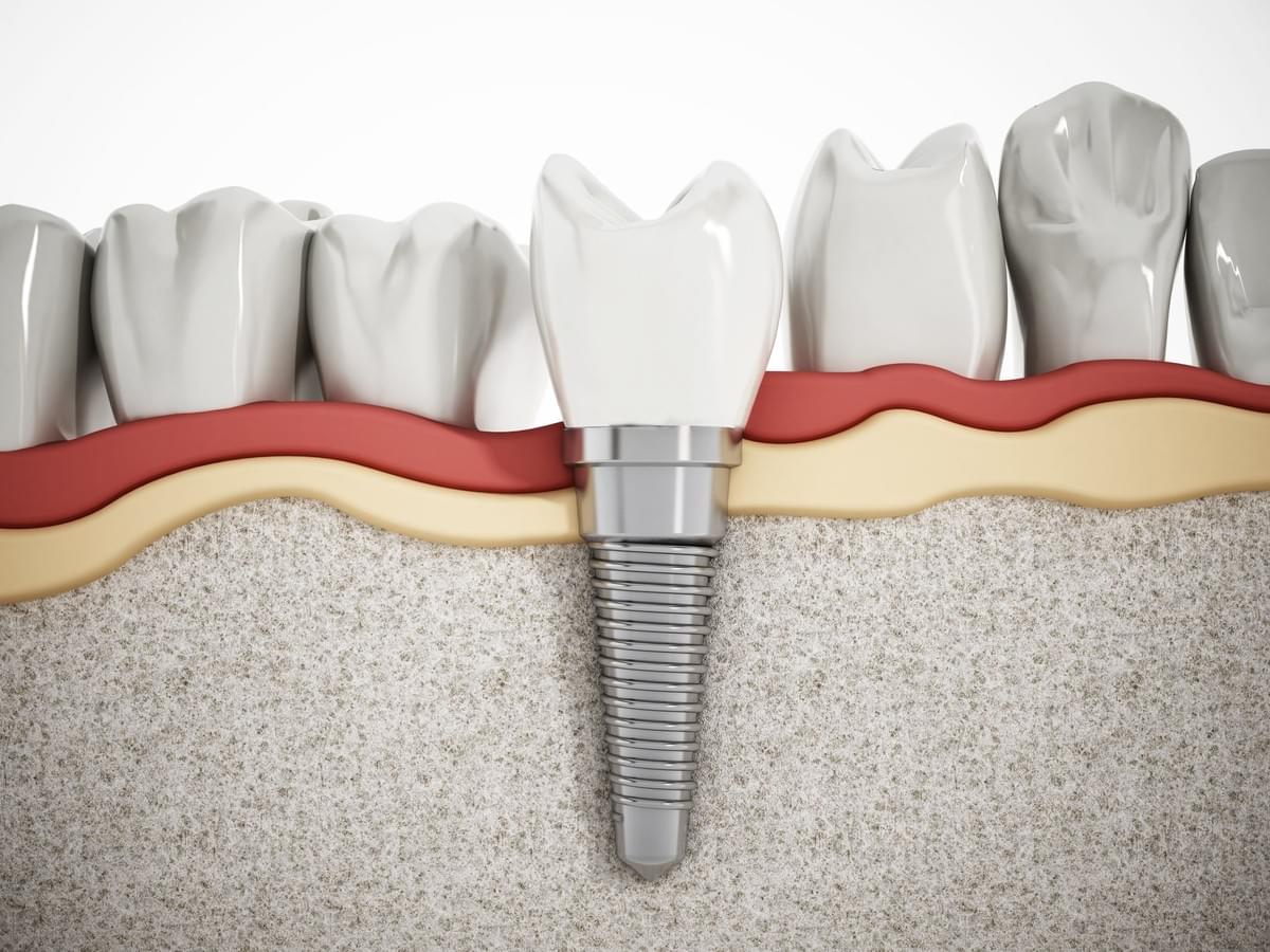Mullingar Dental Center - Implants Mullingar Dental Center - Implants