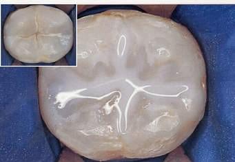 Fissure Sealants - Mullingar Dental Centre, family dentist Fissure Sealants - Mullingar Dental Centre, family dentist