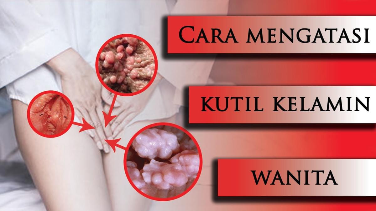 Cara Mengobati Kutil Kelamin Dengan Cara Tradisional Cara Mengobati Kutil Kelamin Dengan Cara Tradisional
