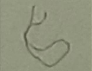 Expelled worm from bladder after subject took praziquantel Expelled worm from bladder after subject took praziquantel