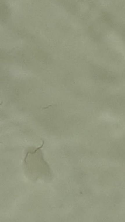 Expelled matter from bladder after subject took praziquantel Expelled matter from bladder after subject took praziquantel