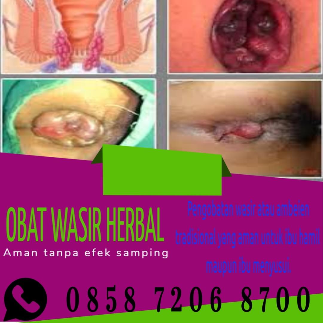 Mengobati Wasir Dengan Minyak Zaitun Mengobati Wasir Dengan Minyak Zaitun