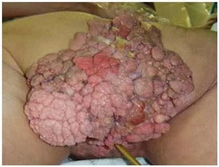 OBAT KUTIL KELAMIN DI APOTIK UNTUK MENYINGKIRKAN VIRUS HPV OBAT KUTIL KELAMIN DI APOTIK UNTUK MENYINGKIRKAN VIRUS HPV