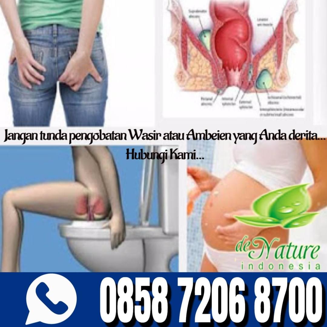 Cara Mengobati Ambeien Atau Wasir Secara Alami Cara Mengobati Ambeien Atau Wasir Secara Alami