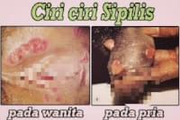 CARA CEPAT MENGATASI GEJALA SIPILIS DENGAN OBAT HERBAL AMPUH CARA CEPAT MENGATASI GEJALA SIPILIS DENGAN OBAT HERBAL AMPUH