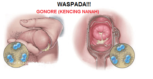 KHASIAT HERBAL AMPUH MENGATASI KENCING NANAH TANPA KE DOKTER KHASIAT HERBAL AMPUH MENGATASI KENCING NANAH TANPA KE DOKTER