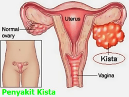 KHASIAT ALAMI AMPUH MENGATASI KISTA OVARIUM TANPA OPERASI KHASIAT ALAMI AMPUH MENGATASI KISTA OVARIUM TANPA OPERASI