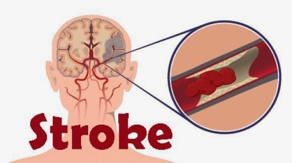 obat stroke bagus obat stroke bagus