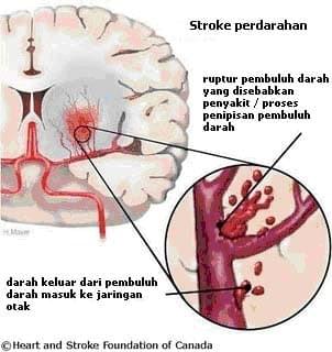 obat stroke apotik obat stroke apotik