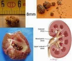 Obat Batu Ginjal Kecil Obat Batu Ginjal Kecil