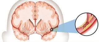 Obat stroke resep dokter Obat stroke resep dokter