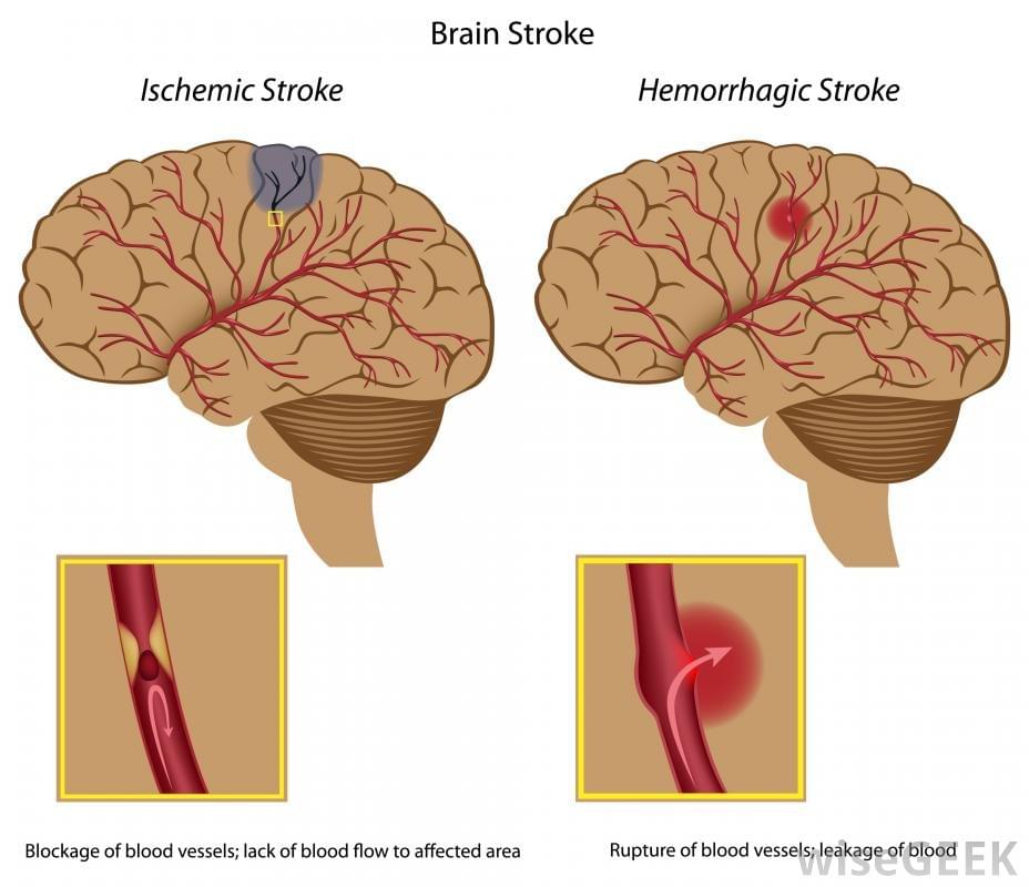 Obat herbal stroke sebelah kiri Obat herbal stroke sebelah kiri
