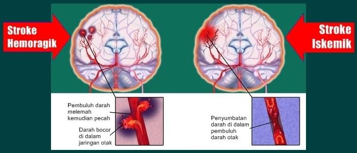 jual obat stroke jual obat stroke