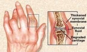 Penyakit Rematik dan Asam Urat Penyakit Rematik dan Asam Urat