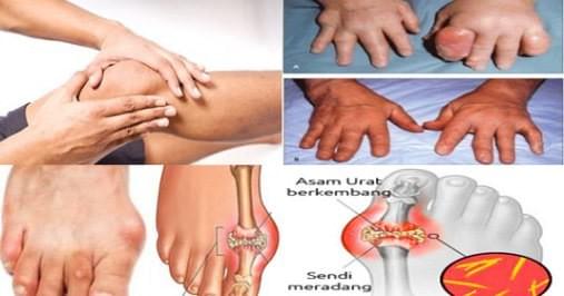 Penyakit Asam Urat Penyakit Asam Urat
