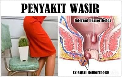 Penyakit Wasir Penyakit Wasir