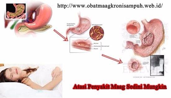 Obat Maag Dosis Tinggi Obat Maag Dosis Tinggi