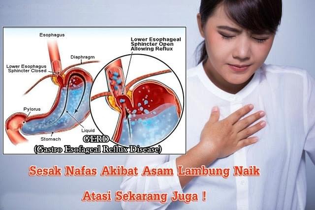 Gerd Kambuh Sesak Nafas Nusagates