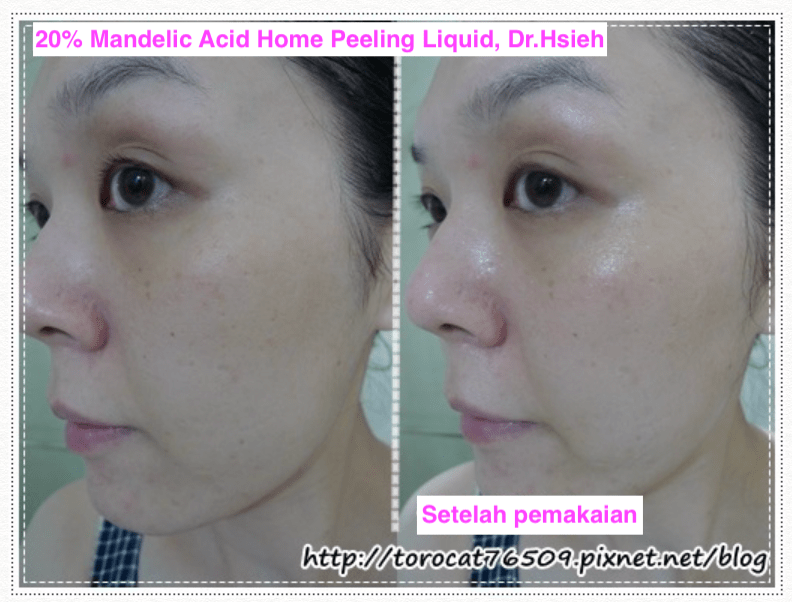 Setelah pemakaian Mandelic Acid Dr.Hsieh Setelah pemakaian Mandelic Acid Dr.Hsieh
