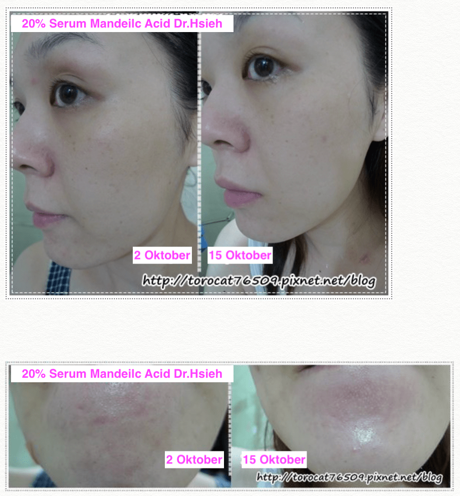 Hasil pemakaian Serum Mandelic Acid Dr.Hsieh Hasil pemakaian Serum Mandelic Acid Dr.Hsieh