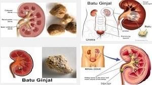 penyakit batu ginjal penyakit batu ginjal