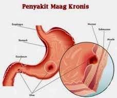 penyakit maag penyakit maag