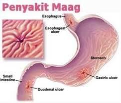 Obat Maag Herbal Paling Manjur Obat Maag Herbal Paling Manjur
