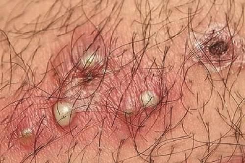 foliculita pe penis