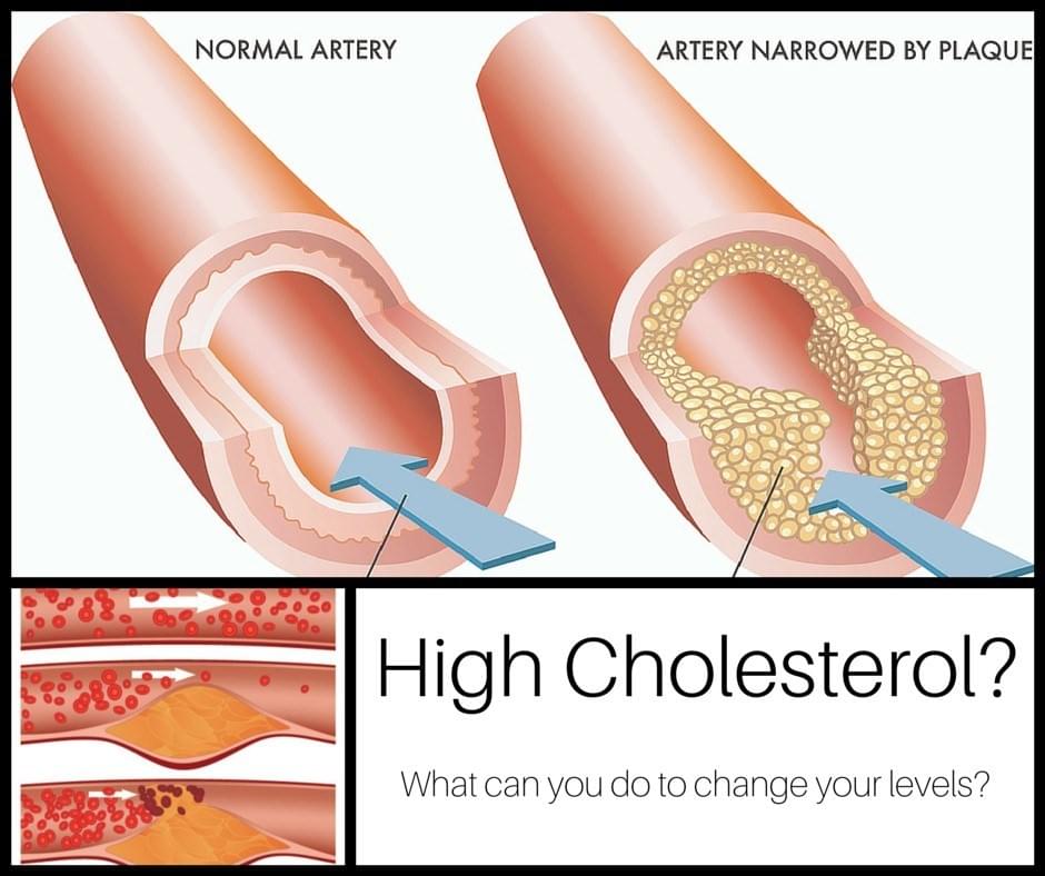 Artery walls narrowed by plaque build up - high cholesterol Artery walls narrowed by plaque build up - high cholesterol