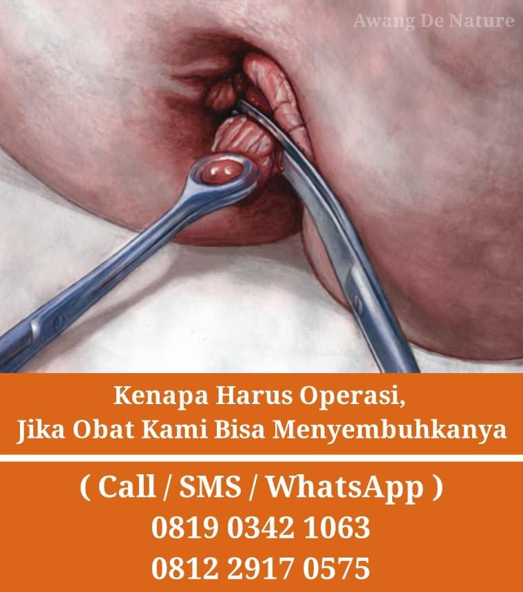 Macam Tablet Obat Bab Berdarah Ada Bengkak Di Bibir Anus Mujarab Obat Wasir Akut Obat Ambeien Obat Wasir