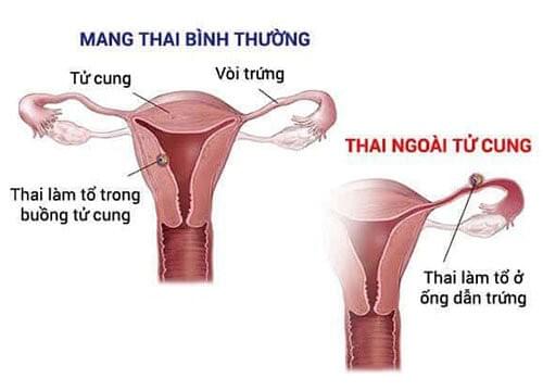 Thai ngoài tử cung Thai ngoài tử cung