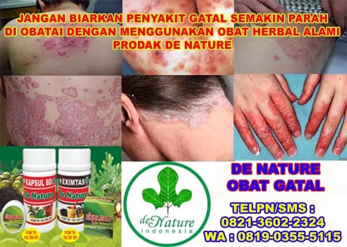 Mengatasi Alergi Kulit Bentol Bentol - Detik Kesehatan