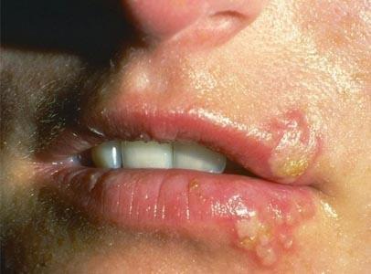 mụn rộp ở môi mụn rộp ở môi