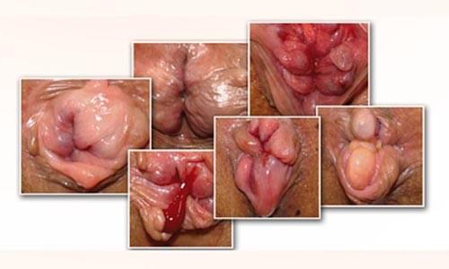 bệnh trĩ là gì? triệu chứng bệnh trĩ bệnh trĩ là gì? triệu chứng bệnh trĩ