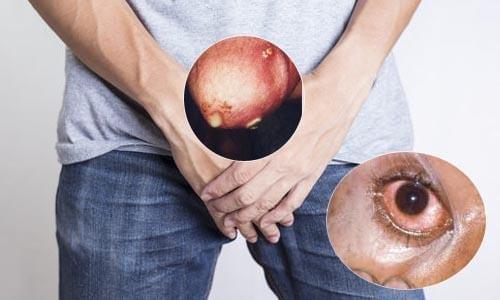 bệnh lậu có chữa được không? bệnh lậu có chữa được không?