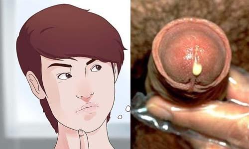 triệu chứng bệnh lậu ở nam giới triệu chứng bệnh lậu ở nam giới